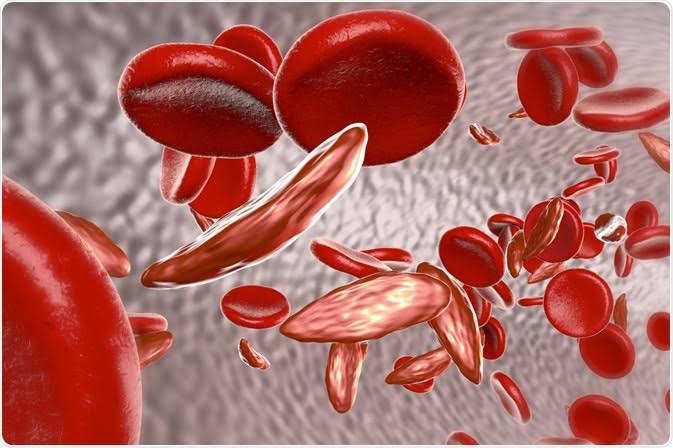 Sickle Cell Awareness Month: New Study Reveals Urgent Need For a National Legal Framework on Sickle Cell Disease in Nigeria